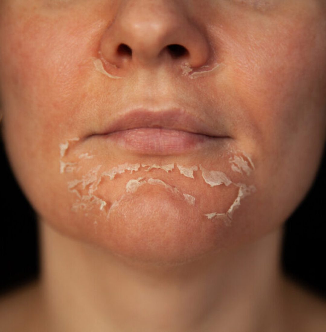 Woman's face after chemical peeling. Peeling skin on the face. Exfoliation of old skin. Facial rejuvenation. Retinoic face peeling